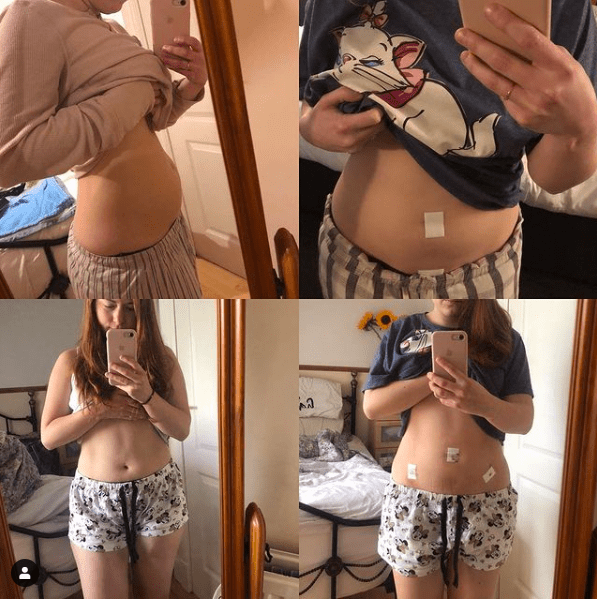 brittneeleysen Endometriosis